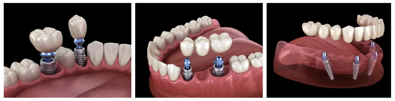 Zubný implantát SK Dental