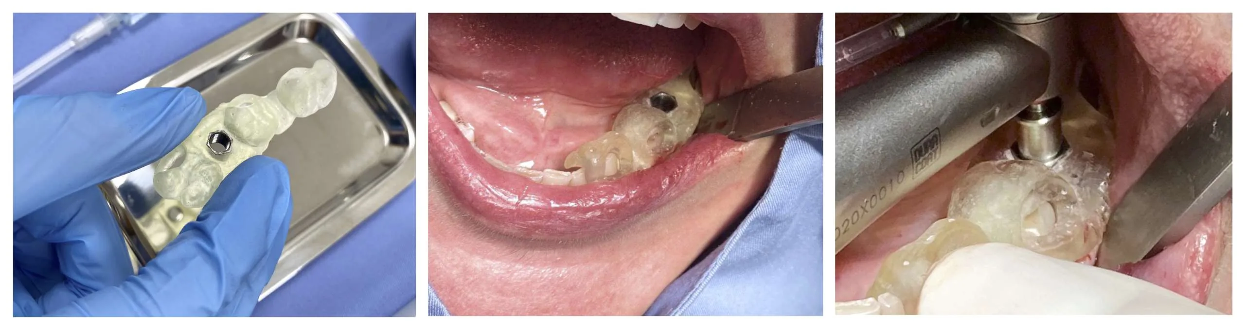 Navigovaná implantológia SK Dental