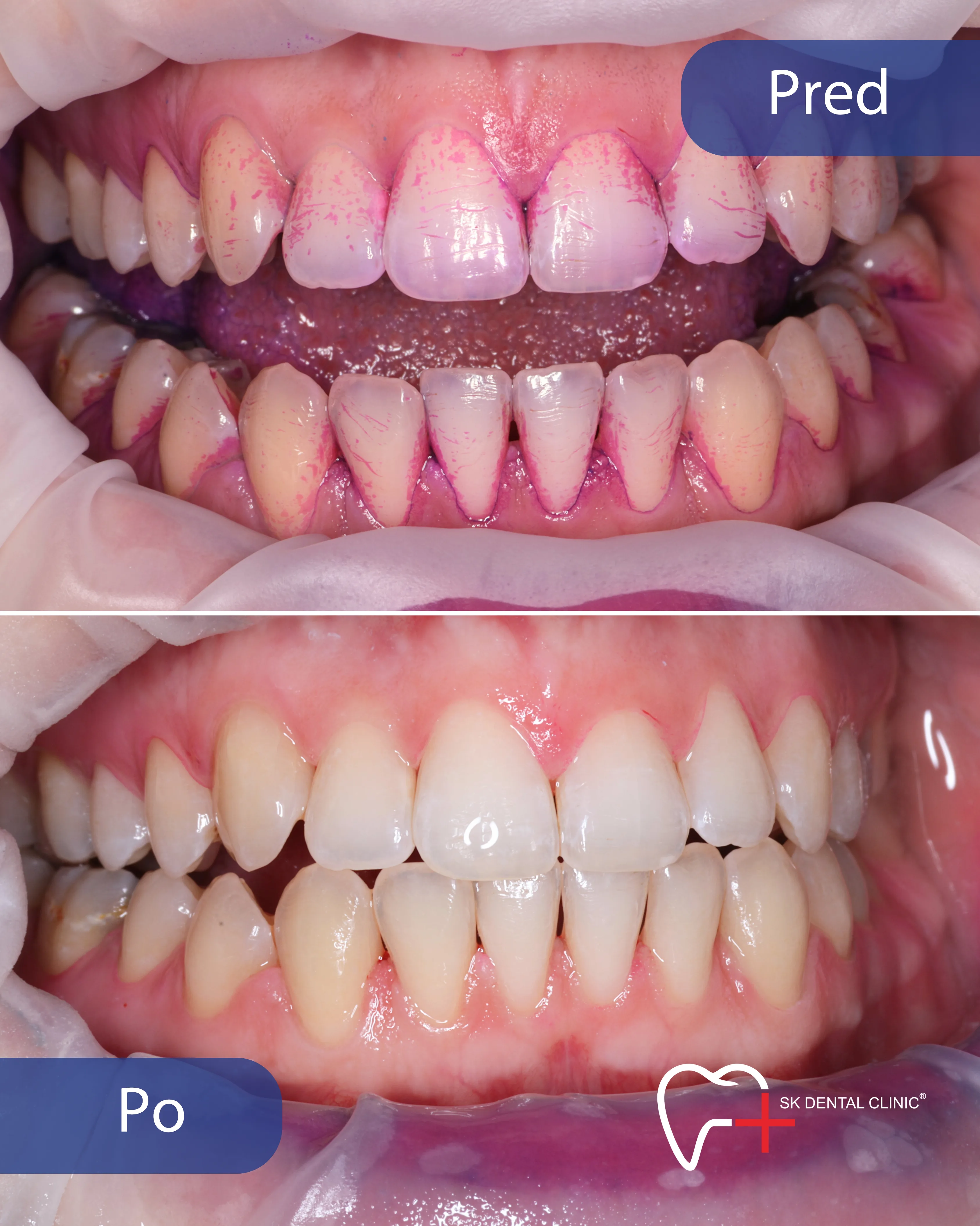 Pred a po dentálna hygiena Bratislava