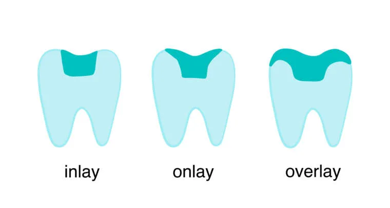 Inlay onlay
