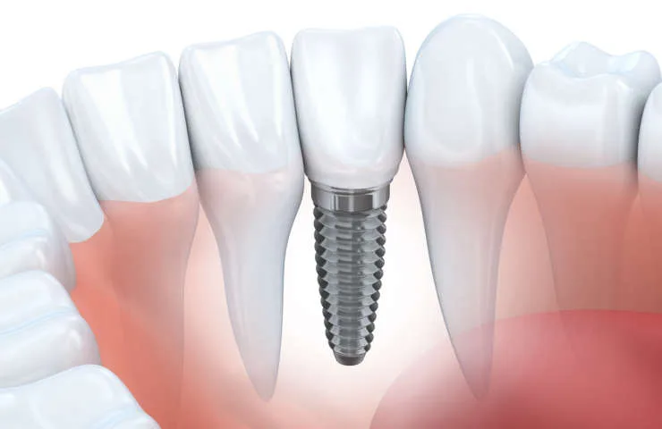 Zubné implantáty